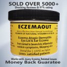 Eczema Psoriasis Rosacea Dermatitis Shingles Acne Anti itch cream