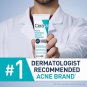 CeraVe Acne Foaming Cream Cleanser | Acne Treatment Face Wash with 4% Benzoyl Peroxide