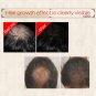 Sevich 30ml Hebal Oil Essence Fast Hair Growth Spray Hair Loss Treatment