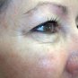 EpiLift Instant Face Lift Serum - 3 Month Supply